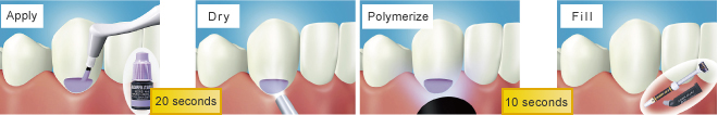 Treatment Method Using CLEARFIL